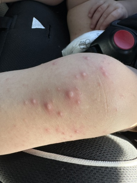 Chicken pox of HFMD?