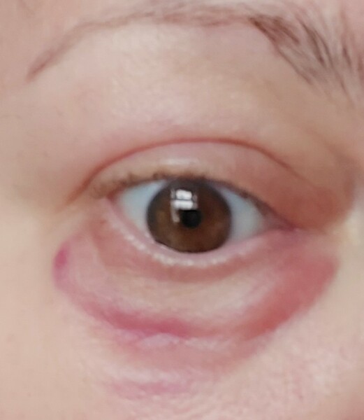 Is this blepharitis?