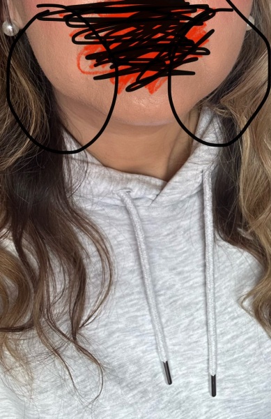 Do you think I need a face lift ?(include pic)