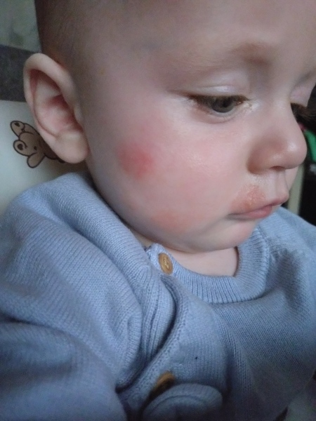 Baby eczema help