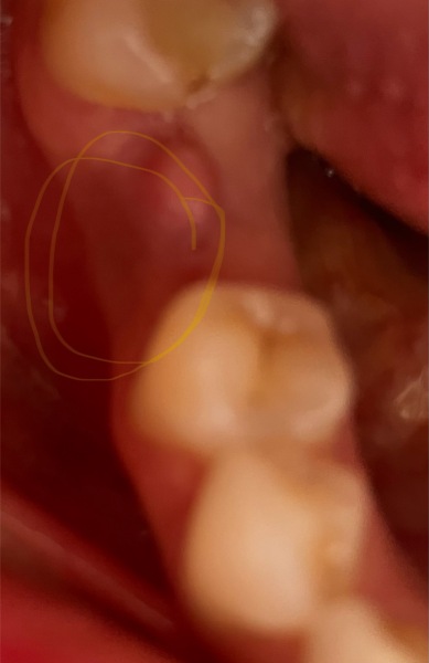 Dentists please help- is this an abscess?