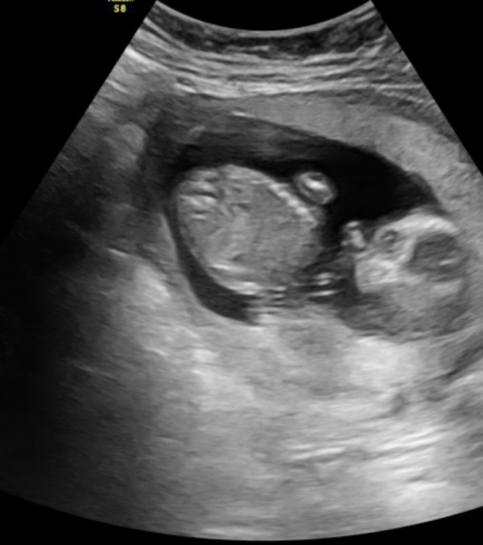 16 week gender scan