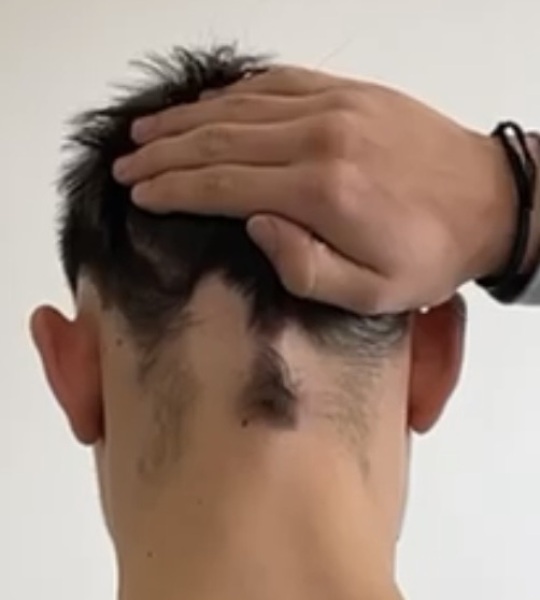 This is alopecia, isn't it?