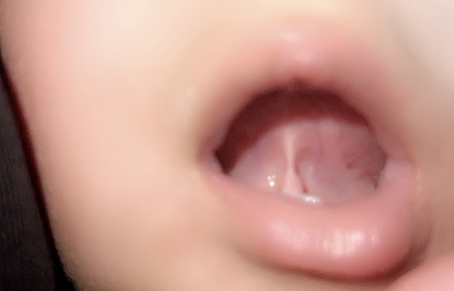 Tongue tie?