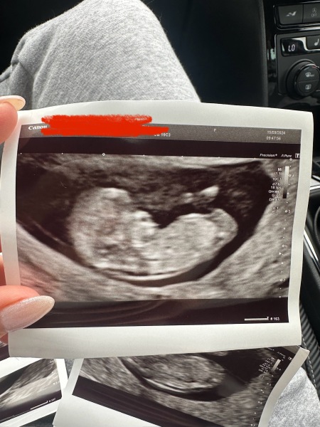Is my 11 weeks and 3 days scan normal?