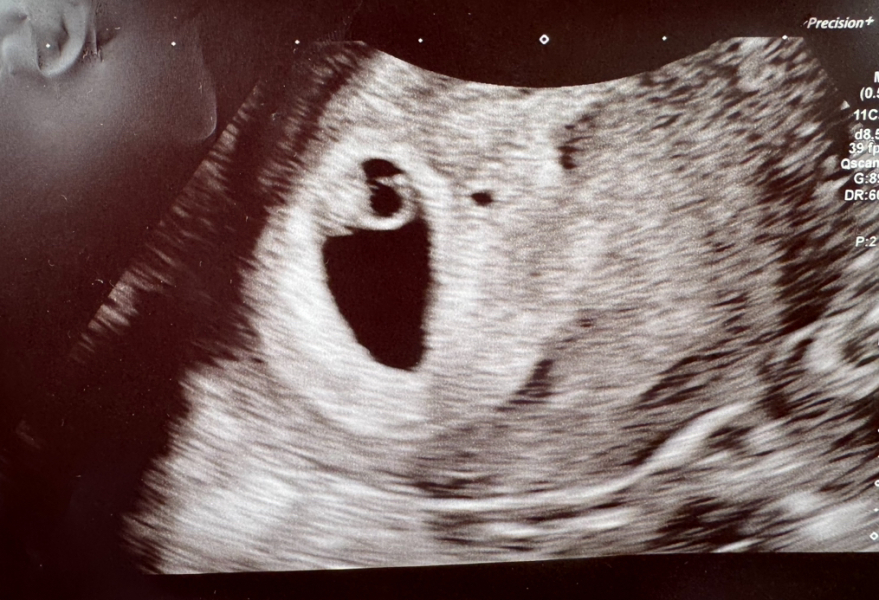 Abdominal scans at 6wks what did you see