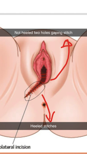 Need episiotomy help so painful