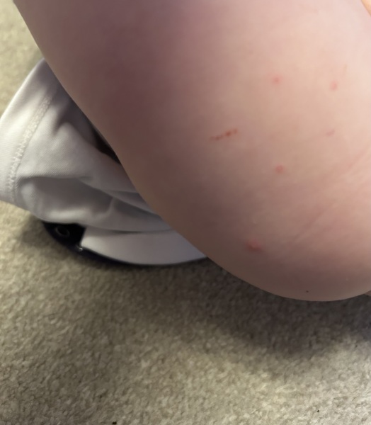 Chicken pox vaccine spots?
