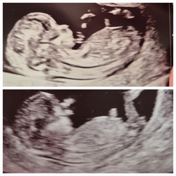 Comparing scans from 1st and 2nd pregnancy