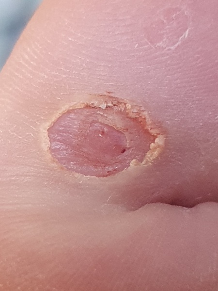 Is this a verruca still?? Picture attached