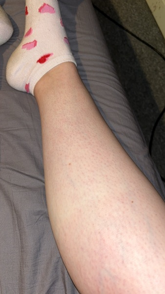 Rash and itch