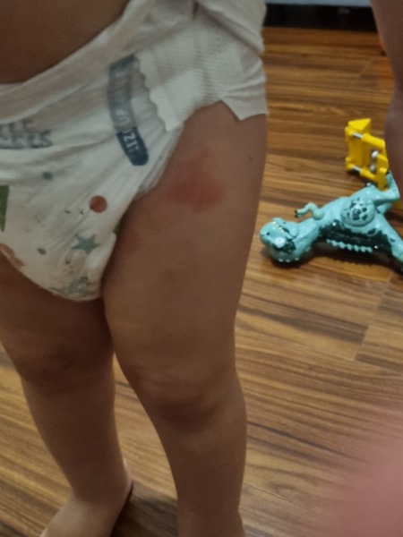Does anyone know what this rash is and how to treat?