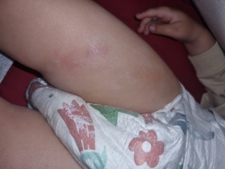 Does anyone know what this rash is and how to treat?