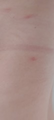 Help me identify bug bites ?
