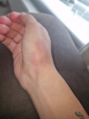 What could this mark on my hand be?