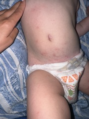 Chicken pox of HFMD?