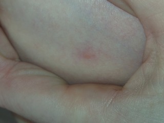 Help me identify bug bites ?