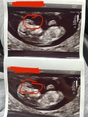 Is my 11 weeks and 3 days scan normal?