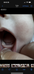 Tooth? Epstein pearls? Or something else