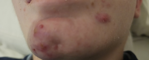 My son has cysts on his face - seeking advice