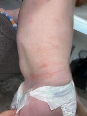 Confused with contact hives...allergy or not?