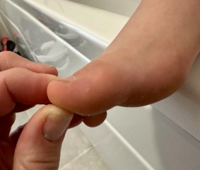 Panicking about how quickly this wart has changed