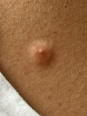 Is this chicken pox? << TW pics included >>