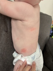 Confused with contact hives...allergy or not?