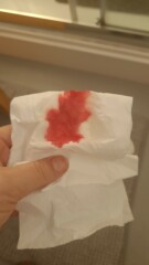 Anyone had Polyps in pregnancy?