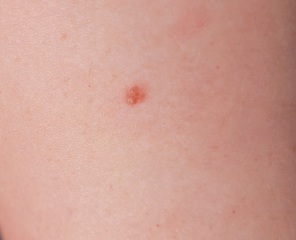 Do you think this mole needs checking