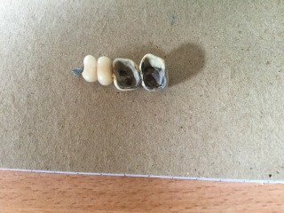 Does anyone have a dental bridge?