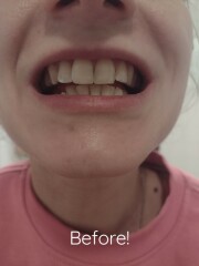 Yellow teeth help