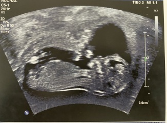 Girl or Boy predictions (13 weeks)