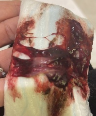 Is this a miscarriage?