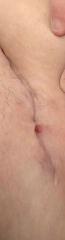 Anyone know what this could be on my c section incision?