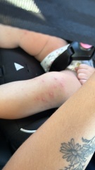 Chicken pox of HFMD?