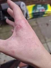 Hand infected (Warning, gross photos)