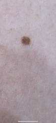 Mole/freckle with white spot on it. Please reassure me. No sinsiter comments please