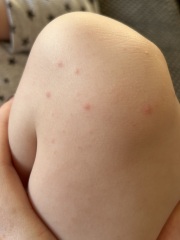 Does anyone recognise this rash/spots?