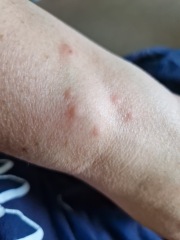 Help! Bedbugs! How did you get rid of yours?