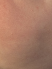 Is this baby acne at 4 months old?
