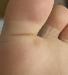 Does these look like verrucas?