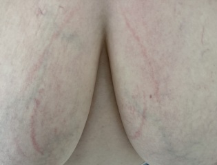 red streaks on breast? not breastfeeding.