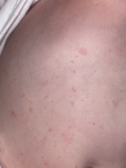 Rash - 1 year old?