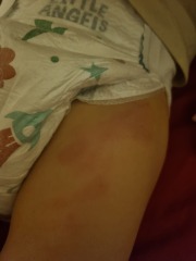 Does anyone know what this rash is and how to treat?