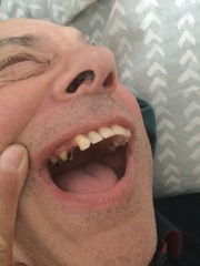 Does anyone have a dental bridge?