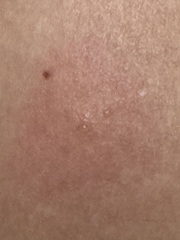 Insect bite (with photos)