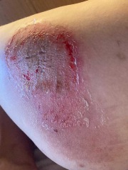 Gravel Burns - Warning Pics included
