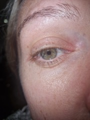 Start of conjunctivitis? Stye??