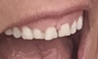 Can you tell me about your composite bonding please?